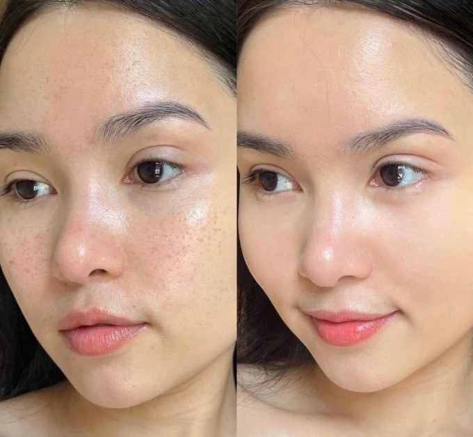 Giảm nám, tàn nhang, mờ thâm sạm, giúp da trắng sáng và đều màu.