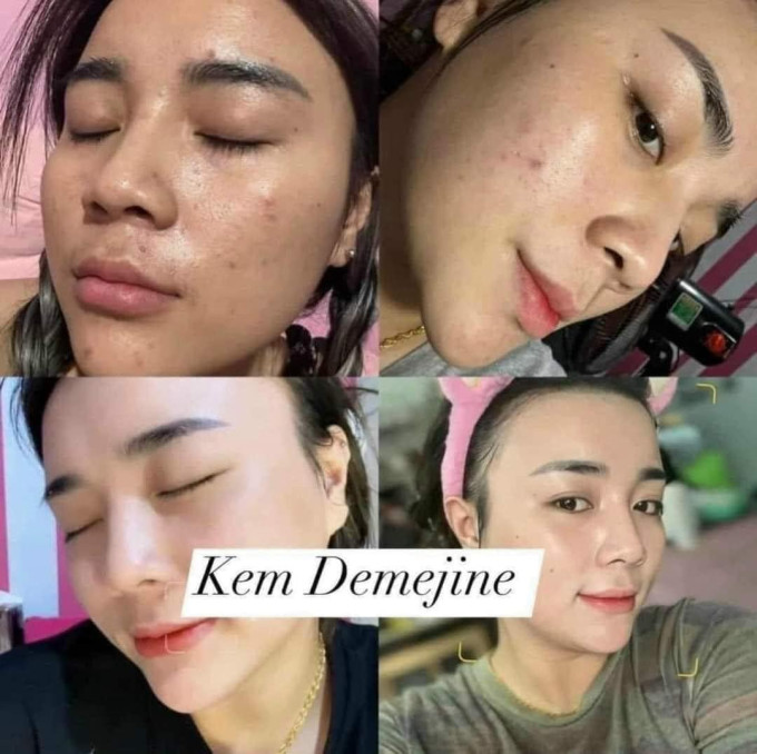 Combo kem Demejine chính hãng ngày & đêm Demejine – Bí quyết dưỡng da trắng hồng, sạch mụn được nhiều khách hàng tin dùng