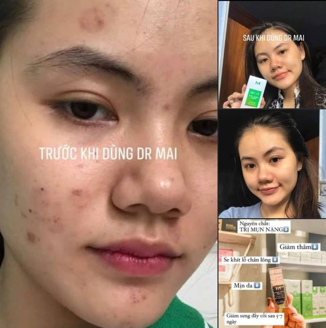 Thành phần tự nhiên – An toàn cho da mụn