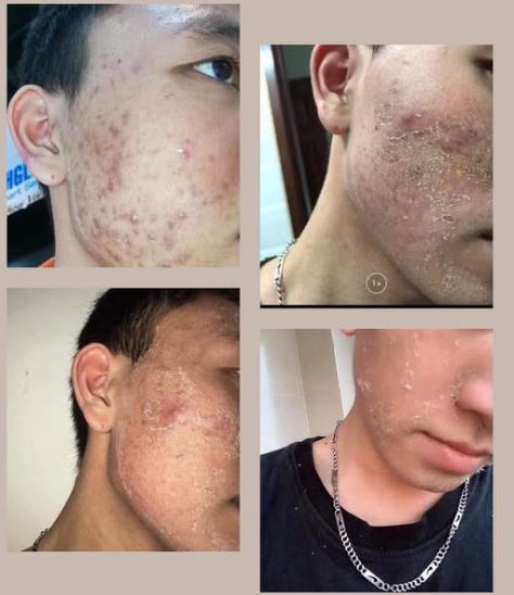 Hỗ trợ điều trị mọi loại mụn: mụn ẩn, mụn viêm, mụn đầu đen, đầu đỏ.