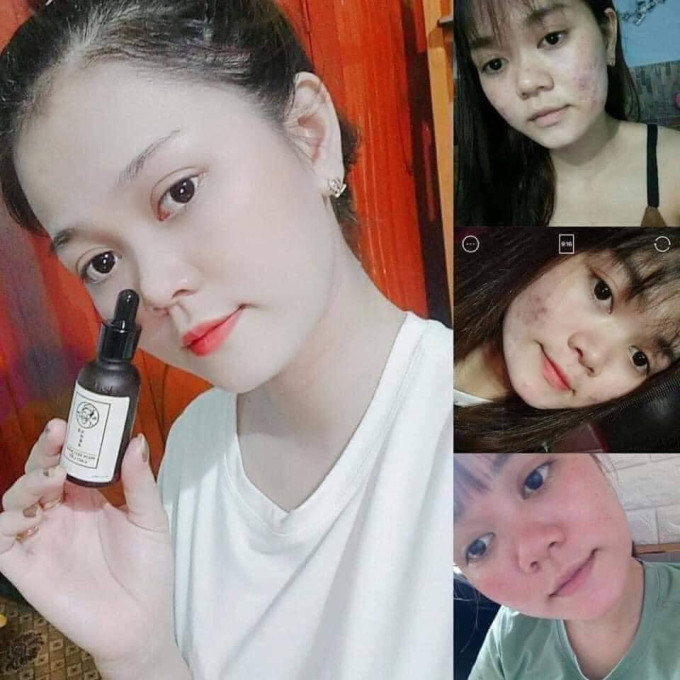 Người có mụn do nội tiết tố hoặc thay đổi sinh lý (tuổi dậy thì, sau sinh).