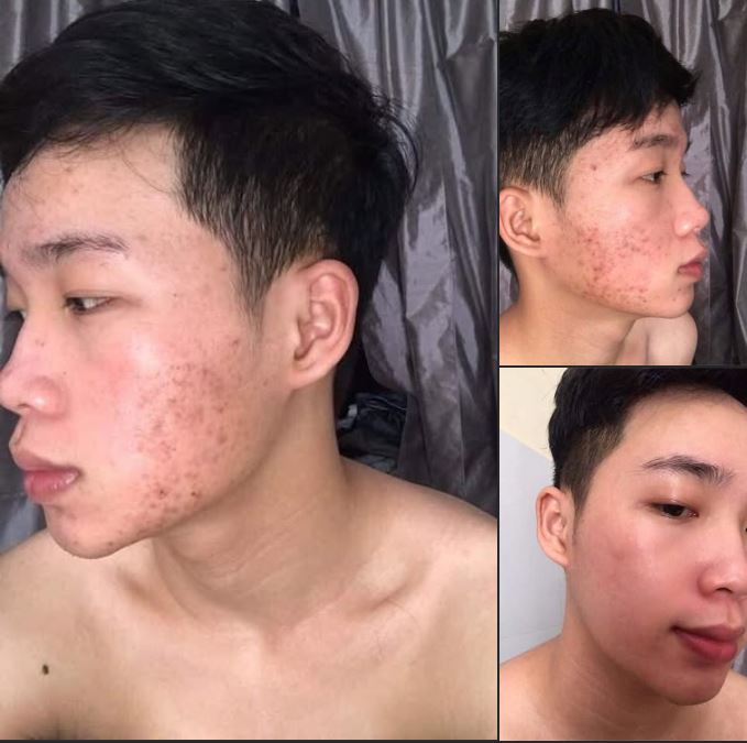 Người bị mụn viêm, mụn ẩn, mụn lâu năm.