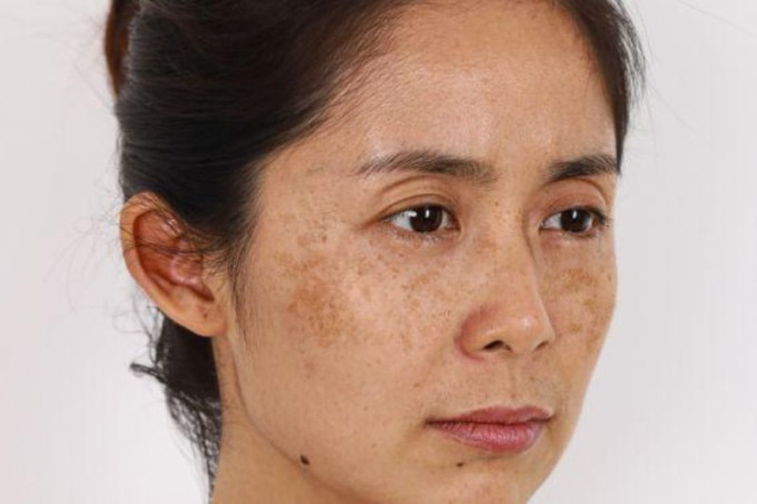 Nguyên Nhân Gây Nám Da Và Cách Chăm Sóc Da Hiệu Quả