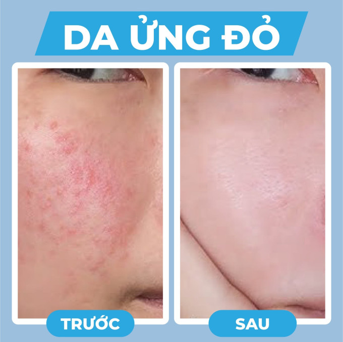 Kem dưỡng Azderma Kem dưỡng ẩm, phục hồi hàng rào bảo vệ chuyên sâu Intensive Moisturising Cream