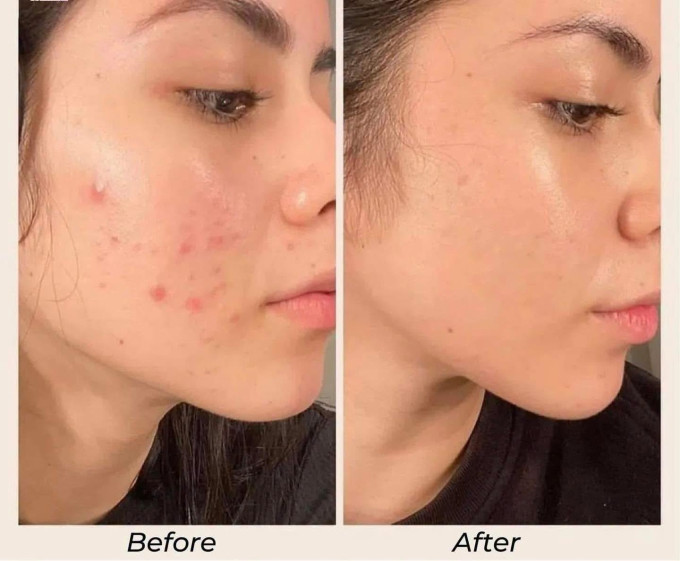 Kem Trị Mụn Klenzit MS 0.1% được nhiều khách hàng dùng hiệu quả